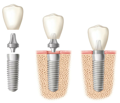 Diagram of three side-by-side dental implants. In the first diagram, all implant components are separate. In the second diagram, the dental crown and abutment are hovering above the implants. In the third diagram, all components are fasted together.