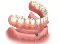 Diagram of a snap-on denture hovering above the jawbone that has two dental implants in it.