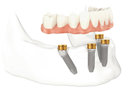 Diagram of four dental implants in the lower jawbone. An arch of teeth is hovering above the implants.