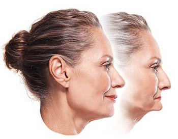 Profile photo of a middle-aged woman with her hair pulled back in the forefront. Her jawbone is intact and supporting her facial muscles. The profile photo beside it shows how her face would look sunken without dental implants to stimulate bone prevent shrinkage; for information on implant overdentures from My Smile Artist in San Antonio.