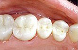 Mercury-free dentist after photo of teeth of composite fillings that replaced old amalgam fillings in three lower molar teeth. Composite fillings are available at My Smile Artist in San Antonio.