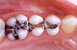 Mercury-free dentist before photo of old amalgam fillings in three lower molar teeth. Composite fillings are available at My Smile Artist in San Antonio.