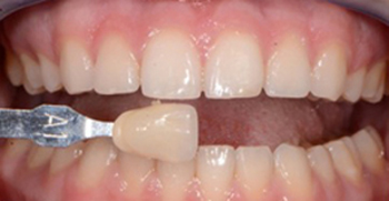 Before teeth whitening photo with slightly yellow teeth that has a tooth color shade marker held next to them.