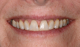 Lips-and-teeth photo of a patient's smile for Digital Smile Design, which is available in San Antonio at My Smile Artist.