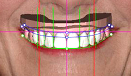 Lips-and-teeth photo of a patient's smile covered with animated proposed teeth changes and diagonal and vertical, green, pink, and red lines through it for Digital Smile Design, which is available in San Antonio at My Smile Artist.